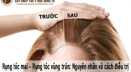 rụng tóc mai