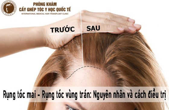 rụng tóc mai