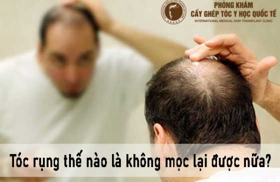 tóc rụng thế nào là không mọc lại được nữa
