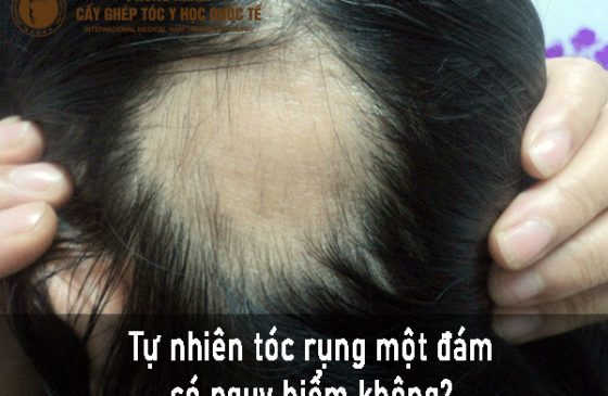 tự nhiên tóc rụng một đám có nguy hiểm không