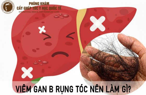 Viêm gan B rụng tóc nên làm gì