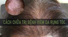 Cách chữa trị bệnh viêm da rụng tóc