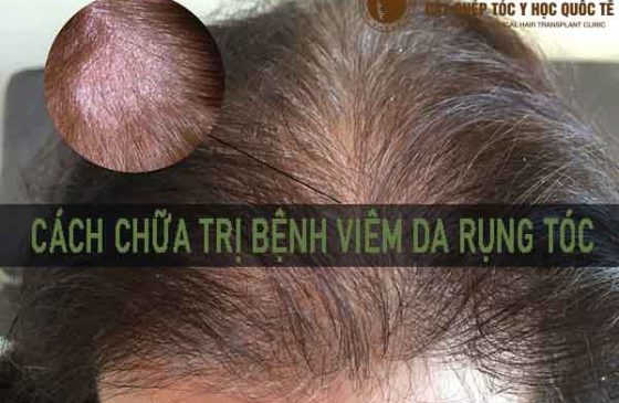 Cách chữa trị bệnh viêm da rụng tóc