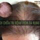 Cách chữa trị bệnh viêm da rụng tóc