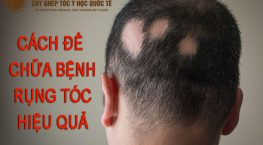 cách để chữa bệnh rụng tóc