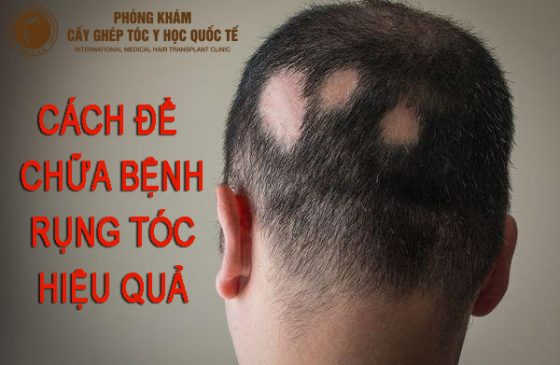 cách để chữa bệnh rụng tóc