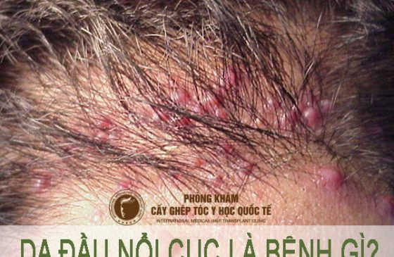 da đầu nổi cục