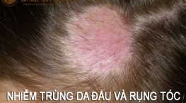 nhiễm trùng da đầu và rụng tóc