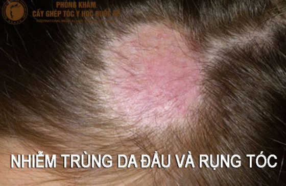 nhiễm trùng da đầu và rụng tóc