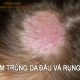 nhiễm trùng da đầu và rụng tóc