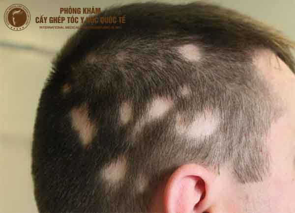 những lí do dẫn đến bệnh rụng tóc tận gốc ở tuổi 15