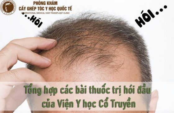 thuốc trị hói đầu của Viện Y học Cổ Truyền