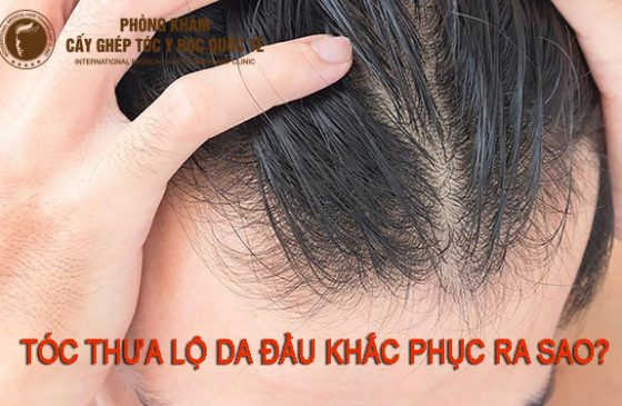 tóc thưa lộ da đầu