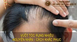 vuốt tóc rụng nhiều