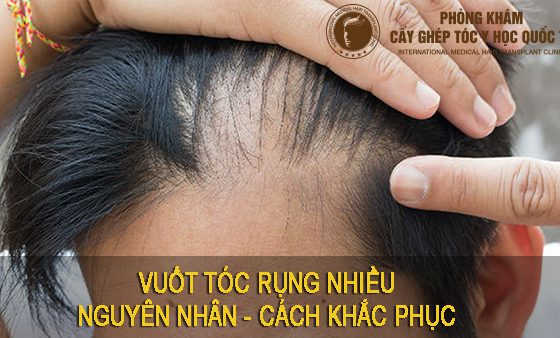 vuốt tóc rụng nhiều
