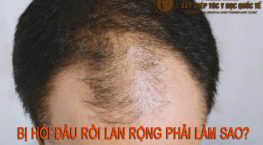 bị hói đầu rồi lan rộng