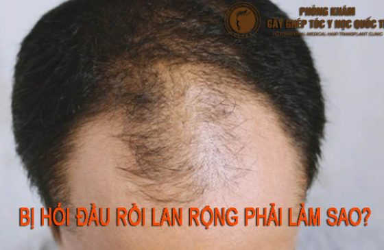 bị hói đầu rồi lan rộng