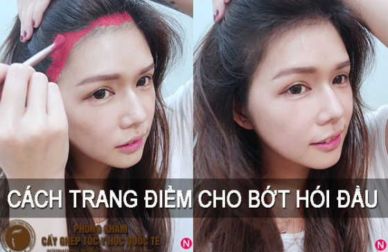 cách trang điểm cho bớt hói đầu