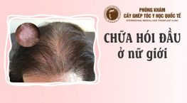 chữa hói đầu ở nữ