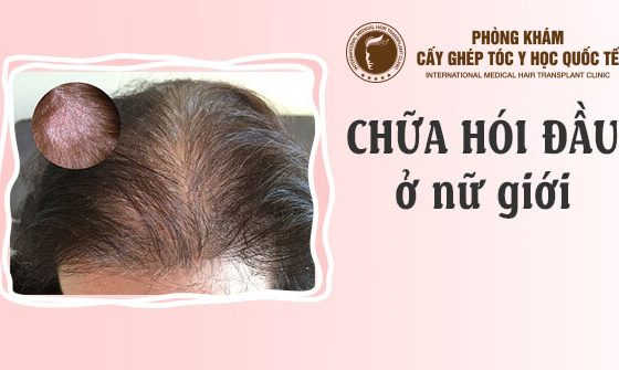 chữa hói đầu ở nữ