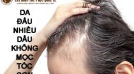 da đầu nhiều dầu không mọc tóc con