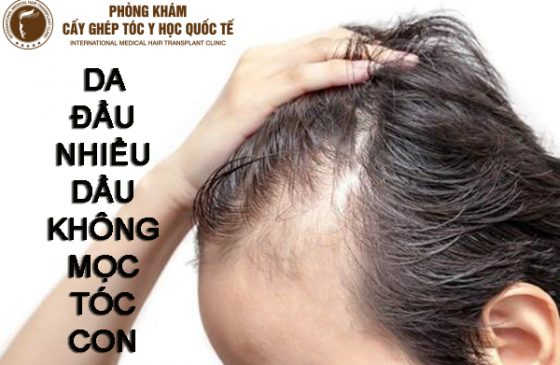 da đầu nhiều dầu không mọc tóc con