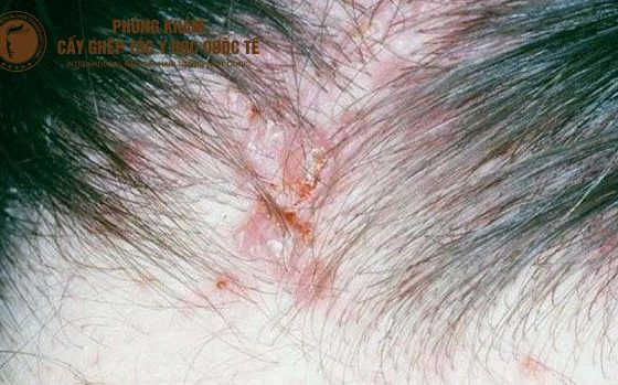 nhiễm trùng viêm nang lông chân tóc