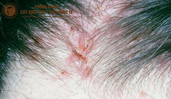 nhiễm trùng viêm nang lông chân tóc