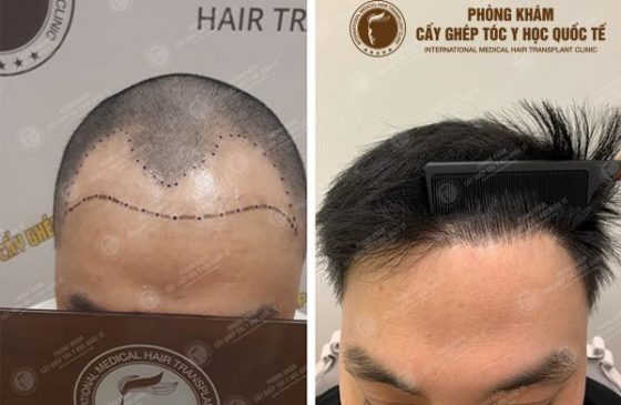 review cấy tóc tự thân