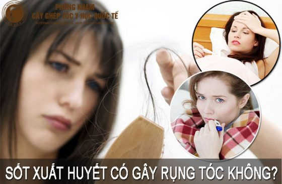 sốt xuất huyết có gây rụng tóc không