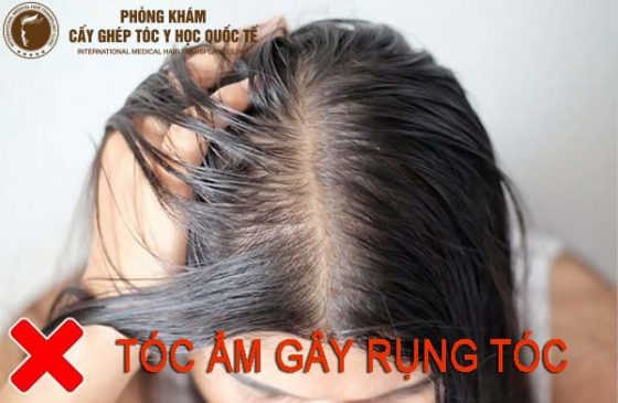 Tóc ẩm gây rụng tóc