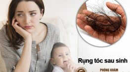 tóc rụng sau sinh phải làm sao