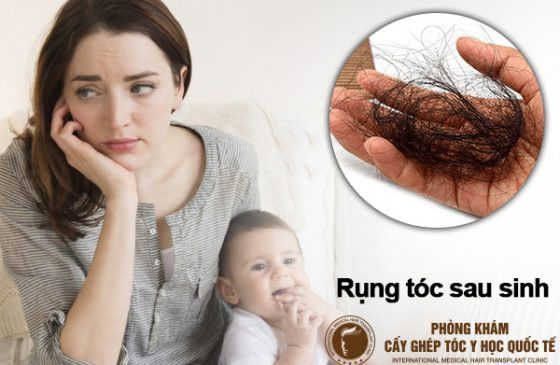 tóc rụng sau sinh phải làm sao
