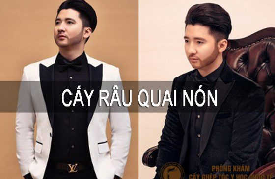 cấy râu quai nón