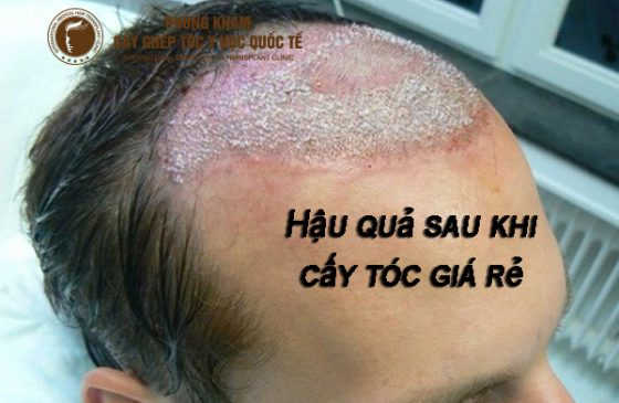 cấy tóc giá rẻ