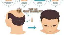 cấy tóc HAT ở đâu