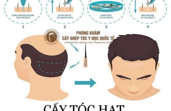 cấy tóc HAT ở đâu