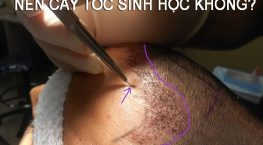 cấy tóc sinh học