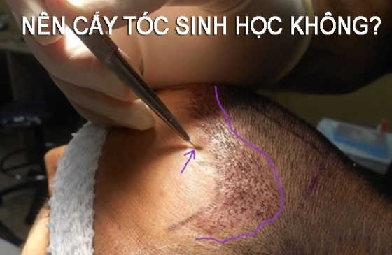 cấy tóc sinh học