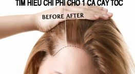 cấy nang tóc bao nhiêu tiền, cấy tóc hết bao nhiêu tiền, cấy tóc tự thân giá bao nhiêu, cấy tóc tự thân giá bao nhiêu, cấy tóc tự thân bao nhiêu tiền, cấy tóc tự thân giá, cấy tóc tự thân, cấy tóc tự thân hết bao nhiêu tiền, giá cấy tóc tự thân, cấy tóc bao nhiêu tiền,