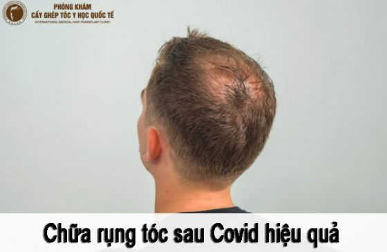 chữa rụng tóc sau covid