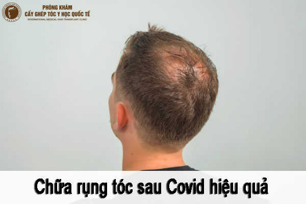 chữa rụng tóc sau covid