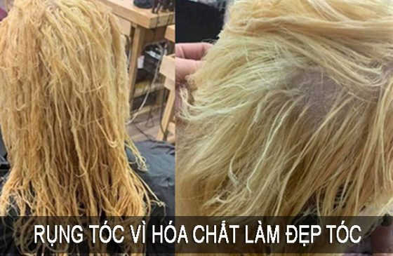 rụng tóc vì hóa chất
