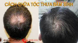 tóc thưa bẩm sinh