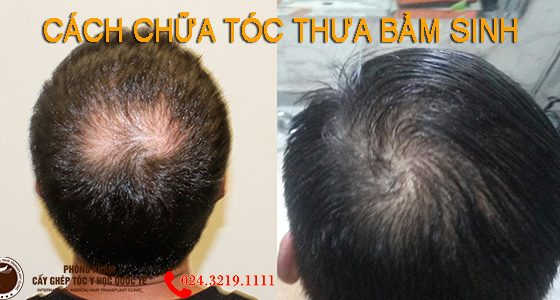 tóc thưa bẩm sinh