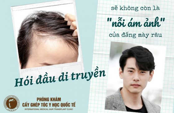 trị hói đầu di truyền