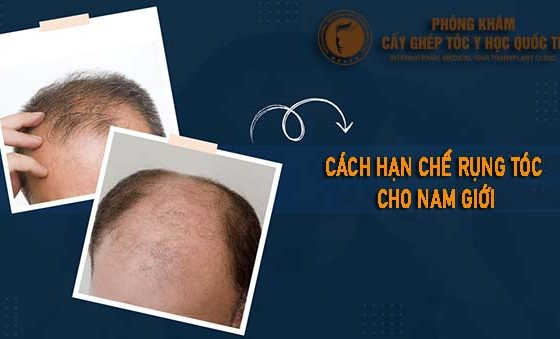 cách hạn chế rụng tóc cho nam giới