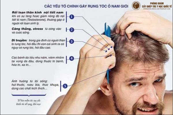 cách hạn chế rụng tóc cho nam giới