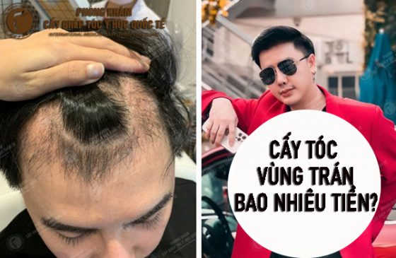 cấy tóc vùng trán bao nhiêu tiền