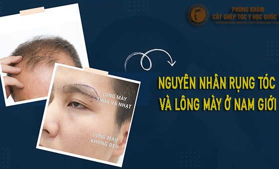 nguyên nhân rụng tóc và lông mày ở nam giới